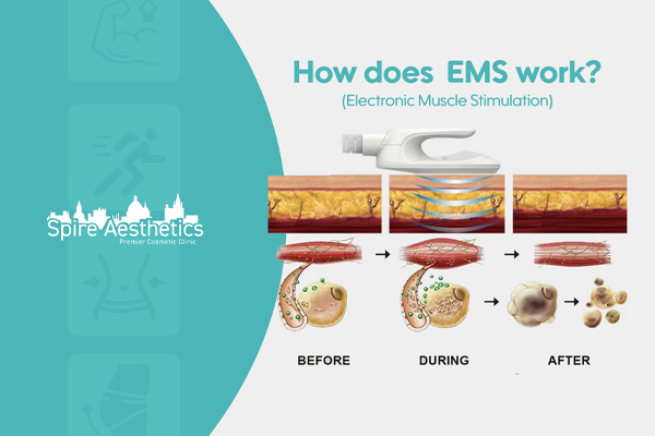 EMS treatment for post pregnancy weight loss treatment Crawley