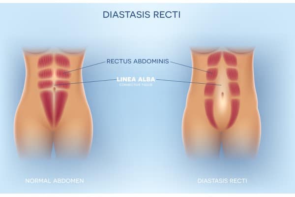 What Non-Surgical Options Are Available for Diastasis Recti Crawley?