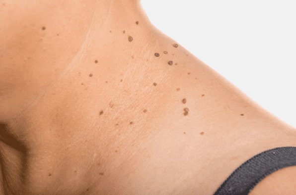 Are you looking for easy skin tag removal Crawley - then contact Spire today!