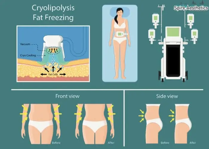 Fat freezing treatment Crawley benefits for competitions to remove stubborn fat deposits.