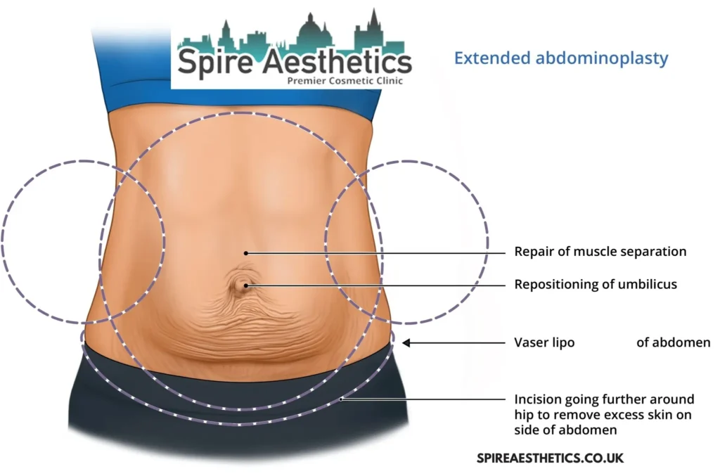 Understanding Loose Skin After Gastric Band Crawley Surgery and HIFU Treatment
