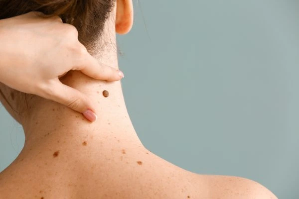 skin blemish removal Crawley treatment
