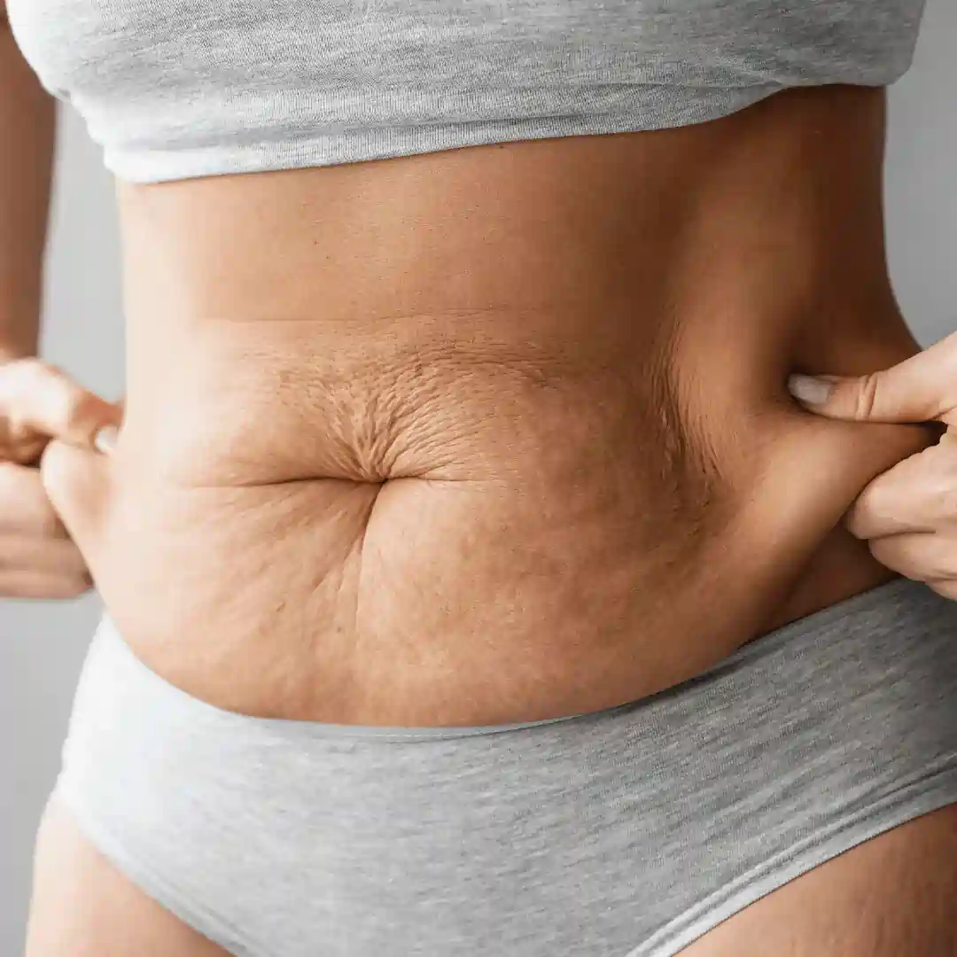 Is It Normal to Have Loose Skin After Pregnancy Crawley?